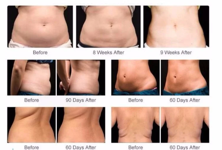 360 Cold Cellulite Cryotherapy Lose Weight Slimming Machine 360 Cryolipolysis  Device