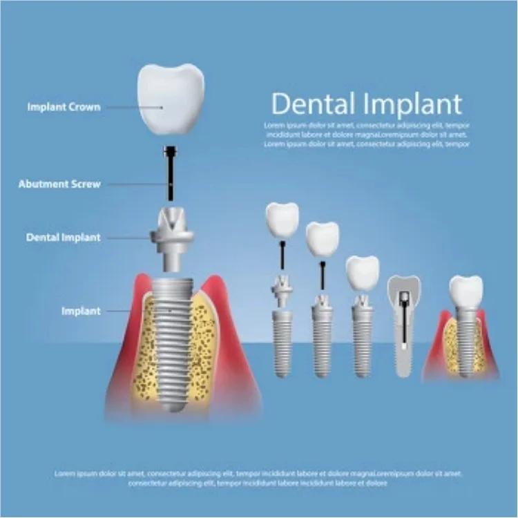 CAD Cam Designed Lab Dental Zirconia Implant Crowns and Bridge Over Titanium Bar