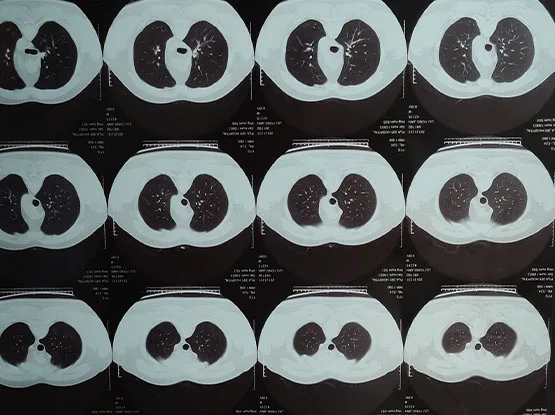 Wholesale Medical x ray film cassette 14*17inch X-ray Cassette Price
