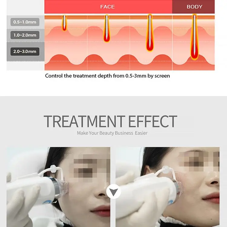 2 в 1 комбинированная машина 980nm Диодная сосудистая фракционная rf микроигла