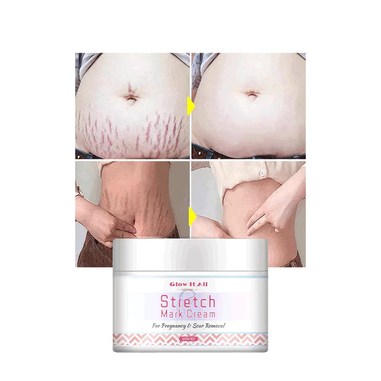 Oem/Odm Mango Stretch Mark Removal Cream Skin Whitening  Cream Pregnancy Scar Private Label Stretch Mark Cream
