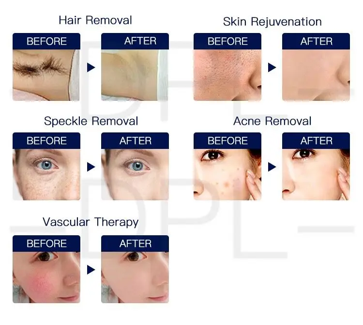 DPL Opt Laser Professional 2 IN 1 IPL Laser Ice Handpiece for Skin Rejuvenation Depilator Hair Removal Machine