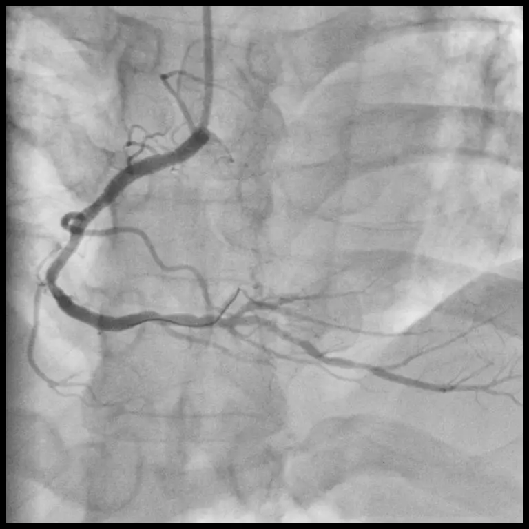 C arm x ray machine for neuro cardiac peripherial  angiography machine with liquid metal bearing x ray tube