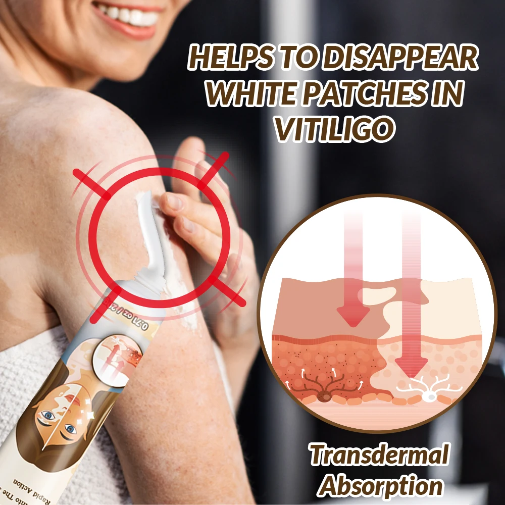Sumifun White Vitiligo Treatment Improve Skin White Spot Relief Ointment