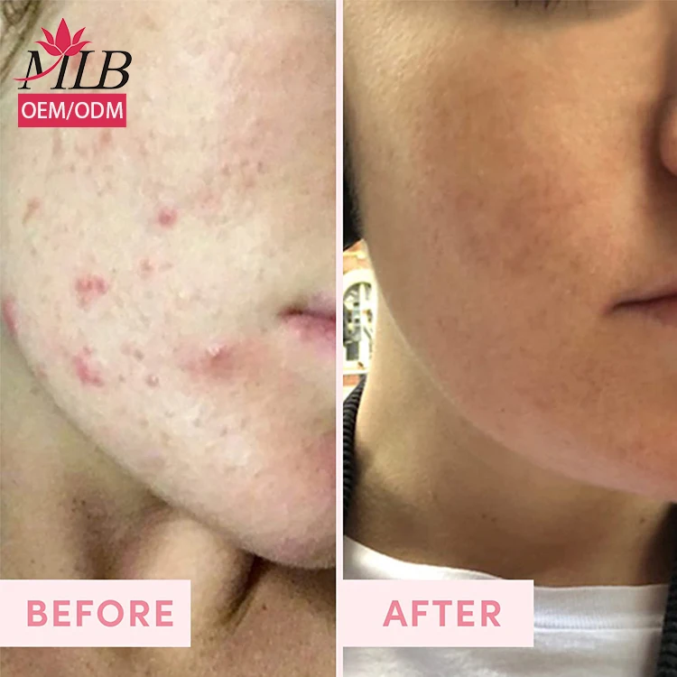 Private Label Pink Clay Mask Rose Face Powder Mask Oem For Facial Mask Oem