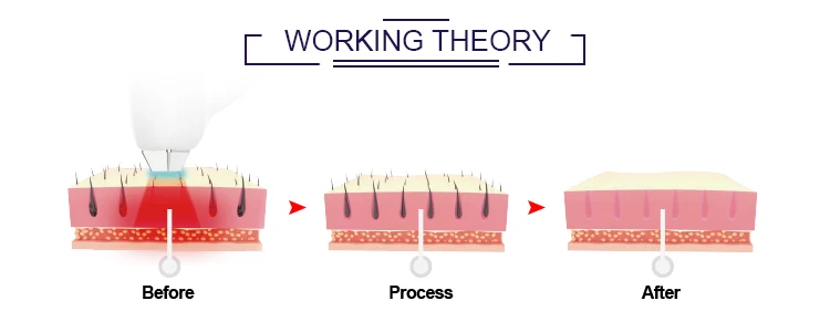 2022 ipl opt laser hair remover epilation skin care machine for beauty salon