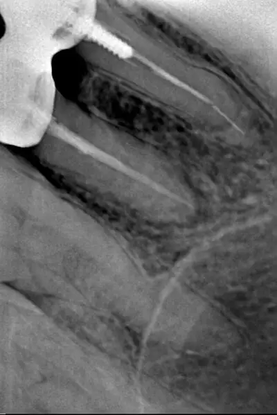 High Quality HDR Intraoral Digital Dental X Ray Rvg Sensor