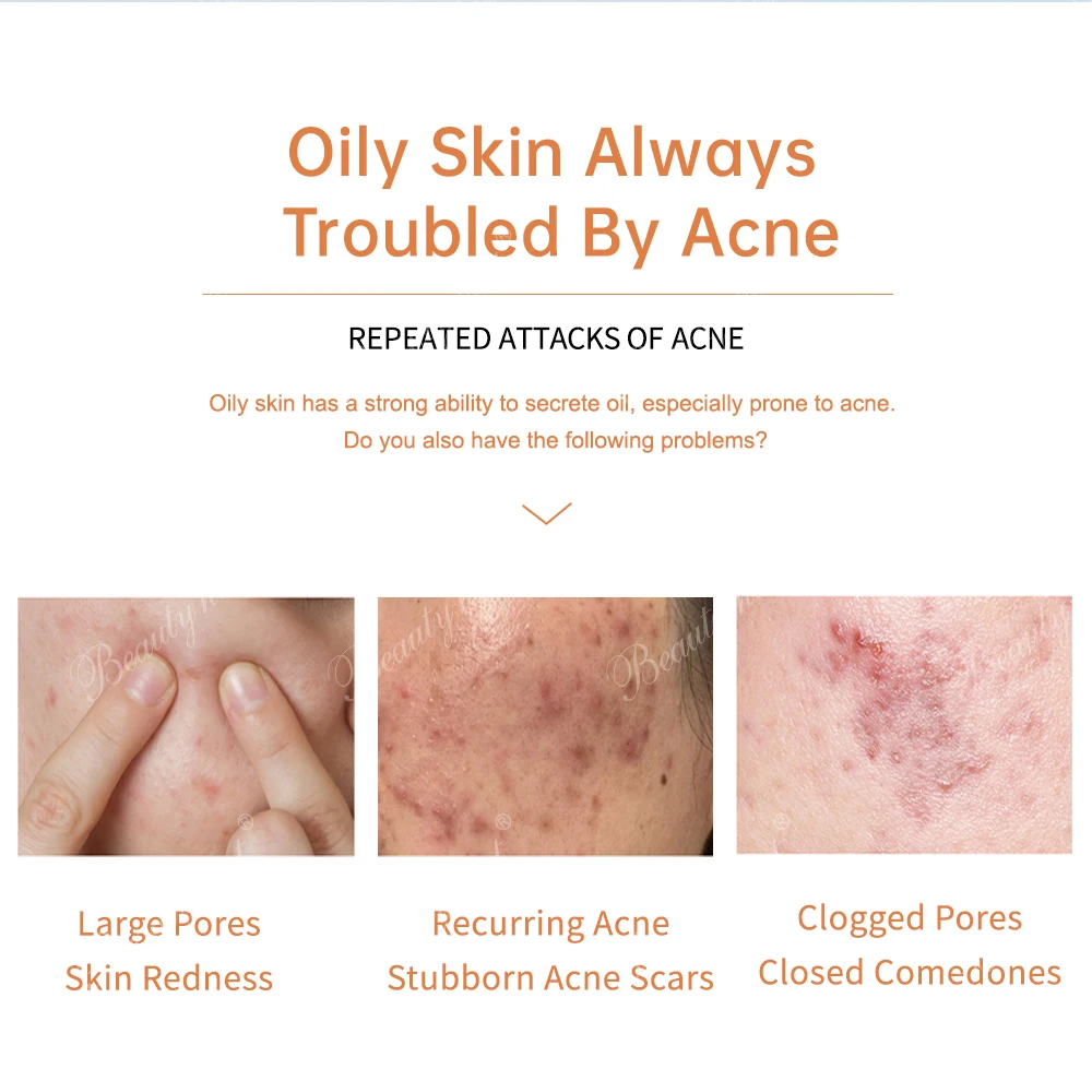 Acne Solution Face Cream Pure Repairing Soothing Acne Scar Removal No Side Effect Moisturizer Glowing Pimple Dark Spot Treatment