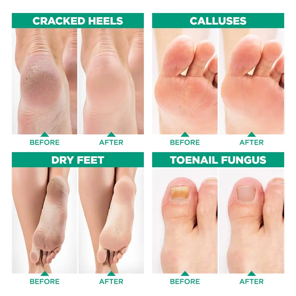 Custom Private Label Natural Tea Tree Oil Exfoliation Calluses Foot Soak Foot Salt