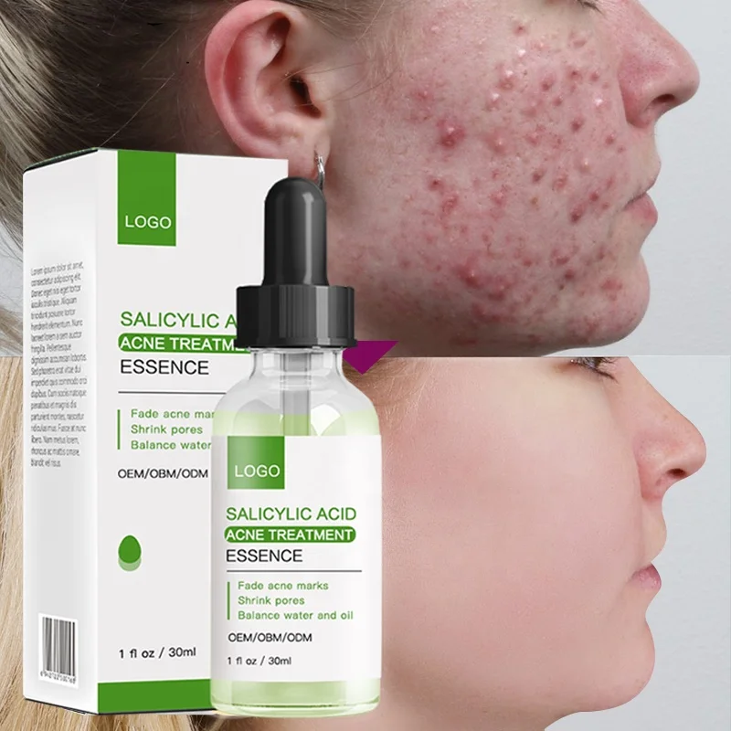 Hot Sales Private label Salicyclic Acid Facial Serum for Acne Treatment Whitening Serum