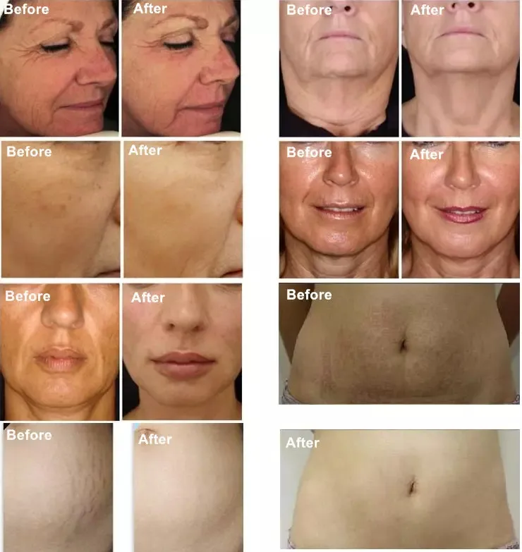 Портативный аппарат для подтяжки кожи лица