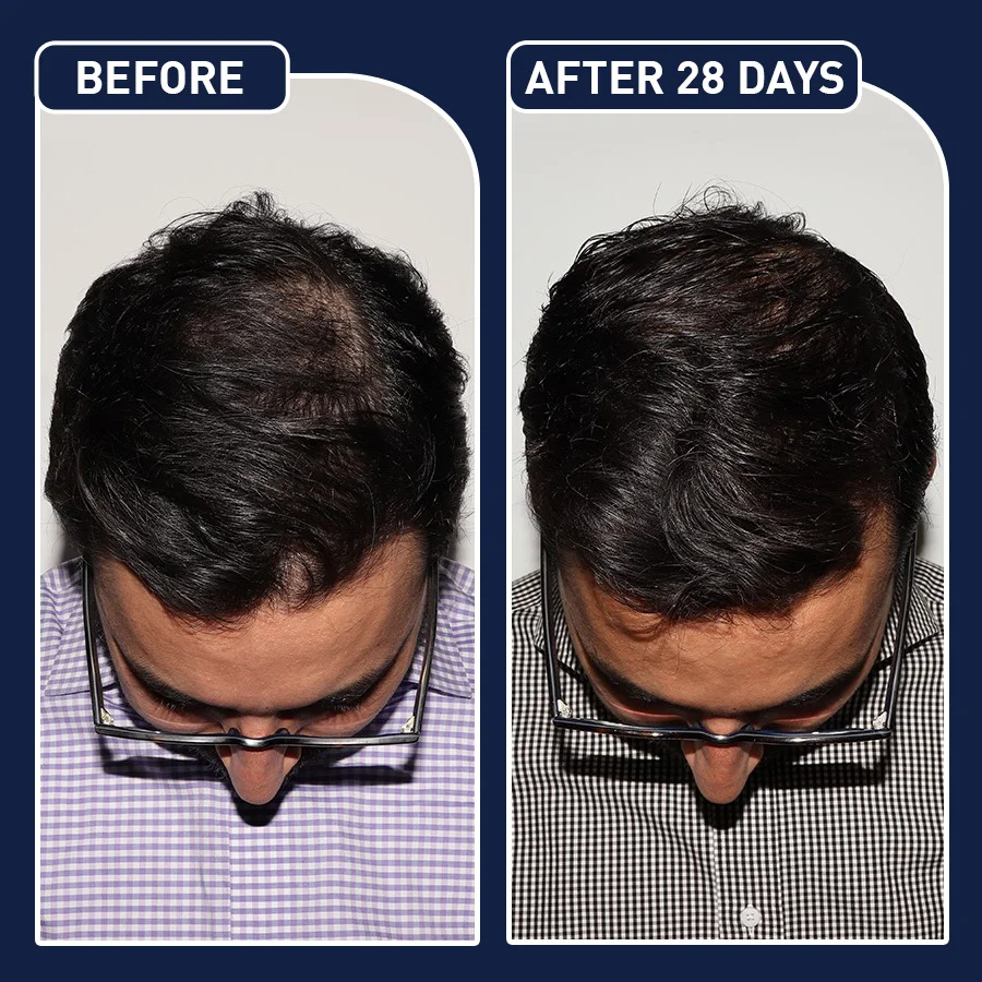 FEG Organic Anti Hair Loss Hair Growth Oil feg hair growth spray