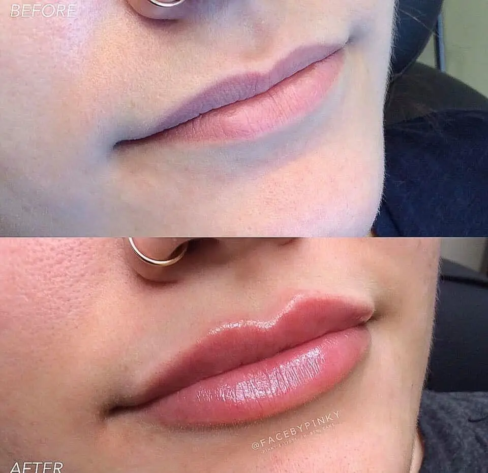 
CE ISO Approved 1ml Hyaluronic Acid Injectable Filler Women Men for Anti Wrinkle Nasolabial Folds with 0.3% Lido 