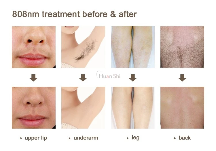 Hot Trending 3 wave long pulse laser hair removal diode machine / laser hair removal for black skin