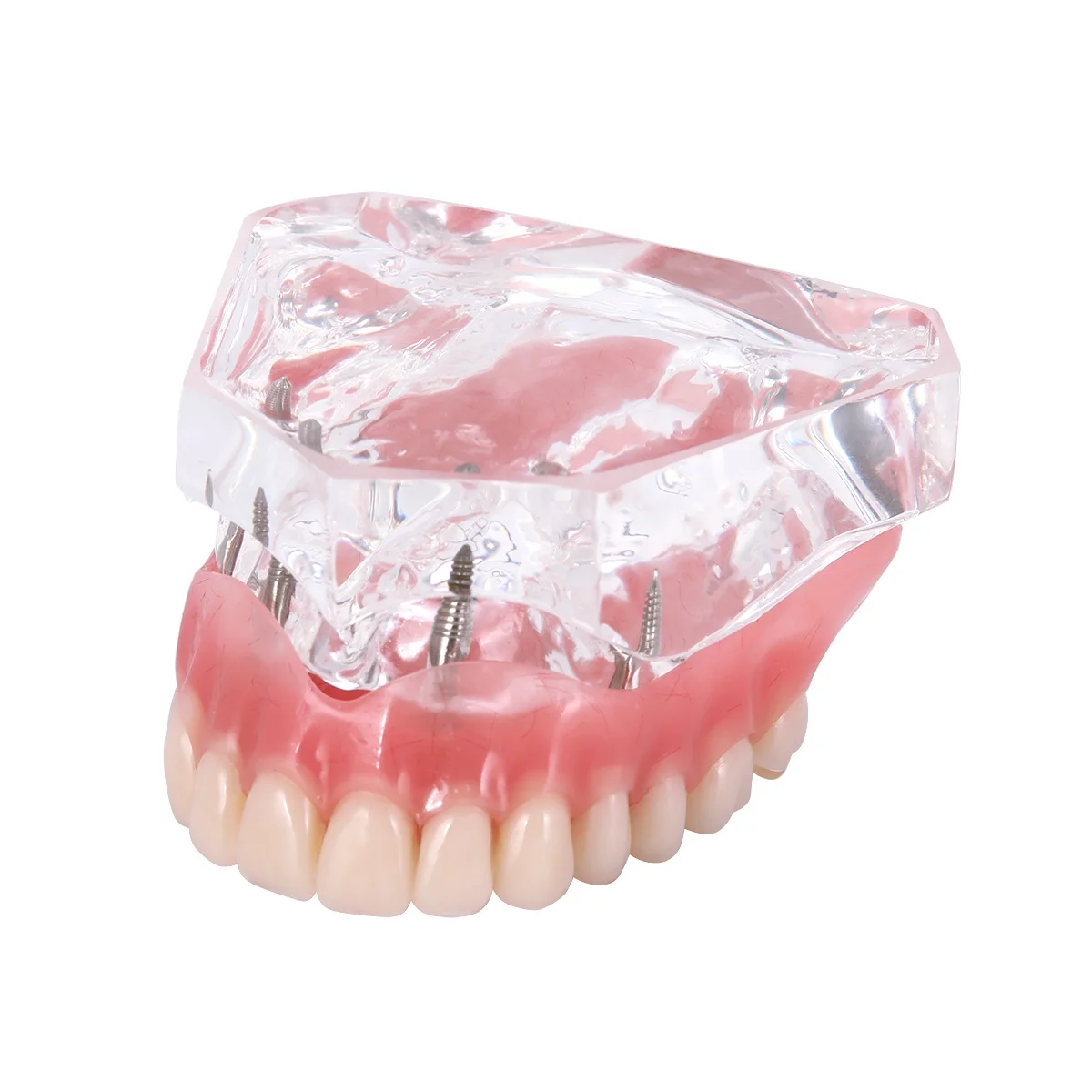 Hot Selling Dental Implant Teeth Model Overdenture Restoration with Implants Upper