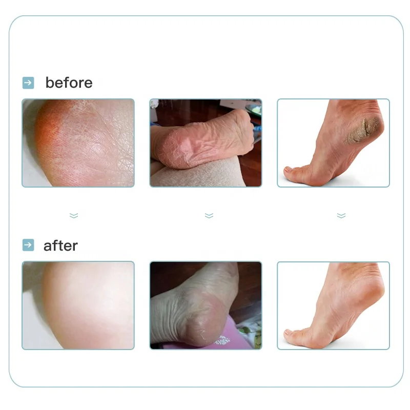 Крем-массажер для рук и ног от производителя отбеливающий оливковое масло с мочевиной увлажняющий натуральный крем