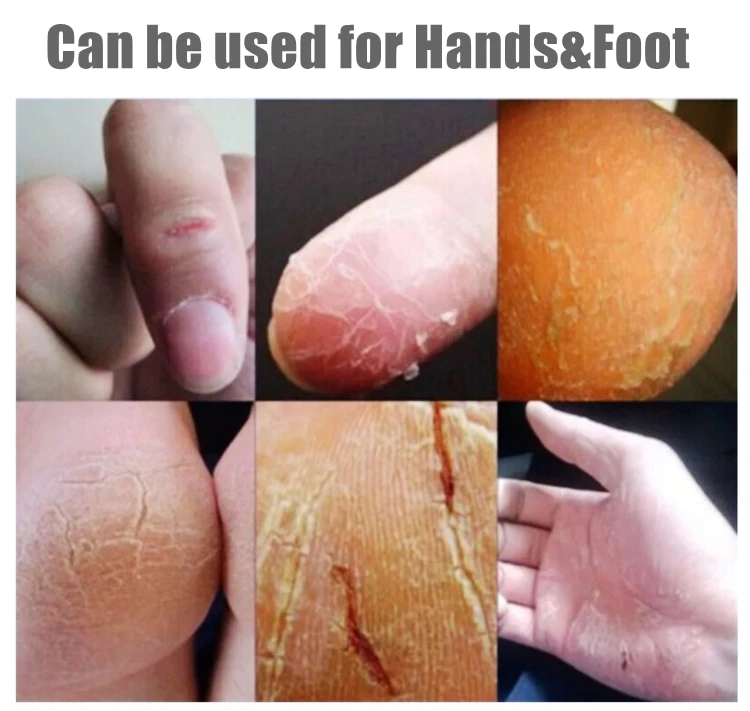 Cracked Heels Dry Hands Skin Softener for Dry Feet Hands Hydrating Smoothing Healthy Feet Moisturizer Dryness Relief Foot Cream