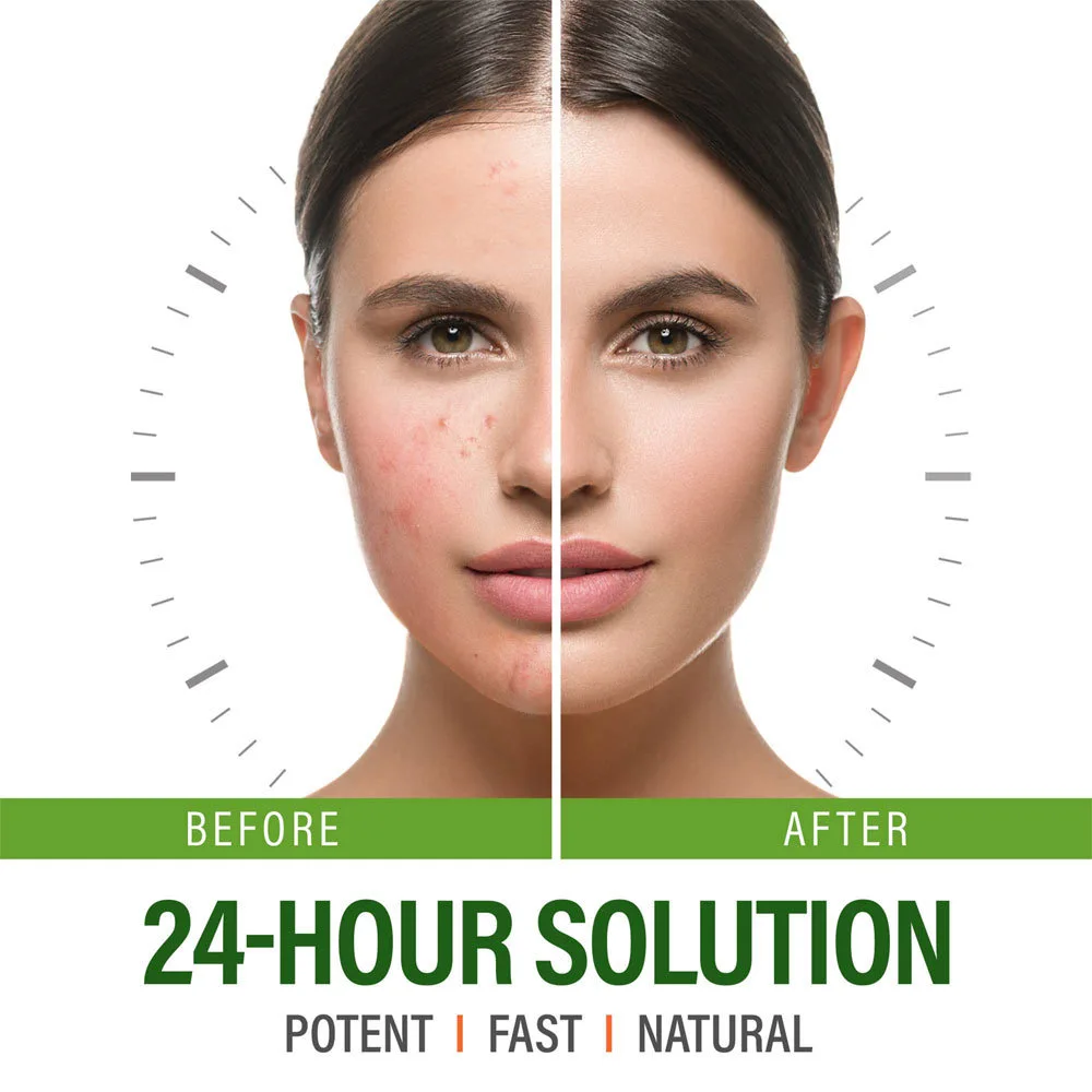 Hot Sale Spot Healing Natural Face Cream Lotion Spot Marks Shrinks Pores Removal Facial Skin Care Cream