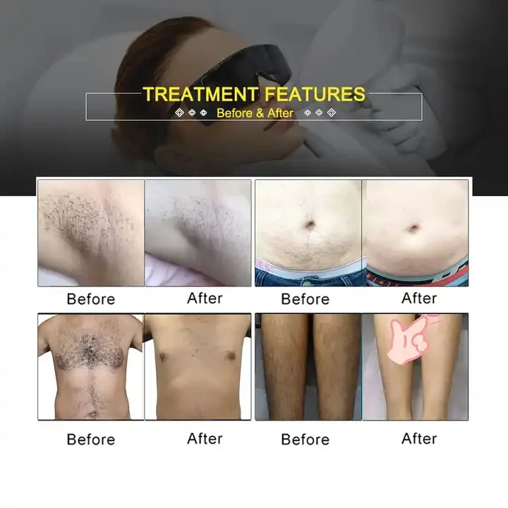 Medical CE 1600w portable 755 808 940 1064nm hair removal laser diode machine alexandrite laser 808 ice laser hair removal price