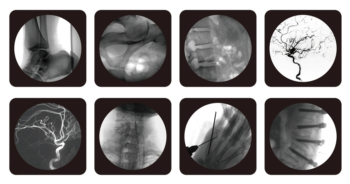 Ce Certificate Professional Ultra-High Frequency Mobile Digital Medical C-Arm X-Ray Machine