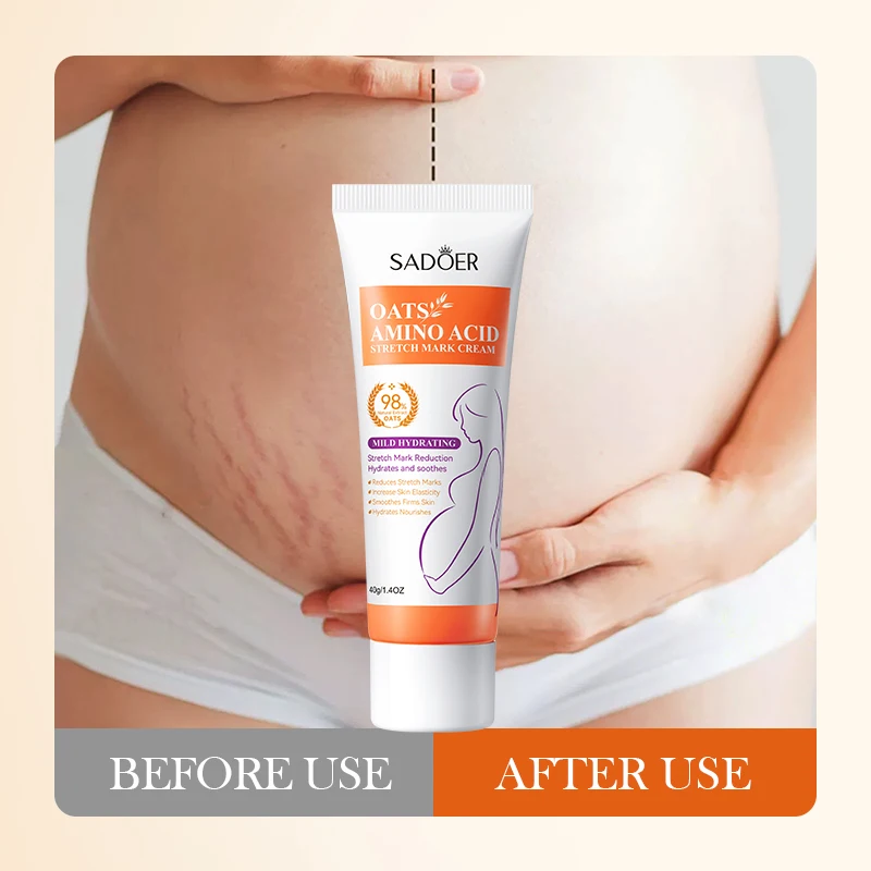 OEM Private Label SADOER Organic Stretch Marks Removal Lotion Repair Whitening Scars Cream Oats Amino Acid Stretch Mark Cream