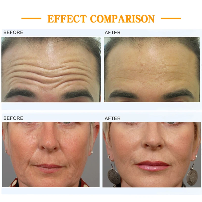 MFFACE Pe-face EMT rf needle-free muscle tone less wrinkles more lift ems facial skin toning machine ems for face