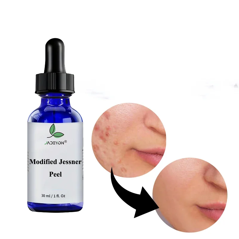 New Arrival Hot Selling  Modified Jessner Peel for Acne Hyperpigmentation Chemical Peel Solution for Skin Whitening