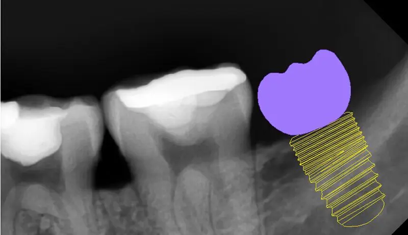Portable Dental Digital X-Ray Machine Camera Type Wireless X-Ray CE Certified CMOS Technical Support