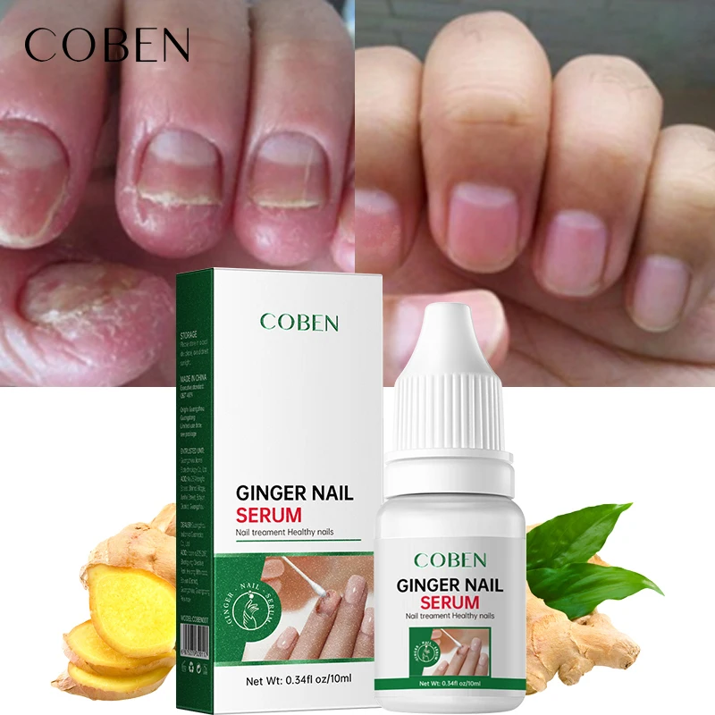 Treatment Nail Repair Pen For Onychomycosis Paronychia Finger Toenail Fungus Infection