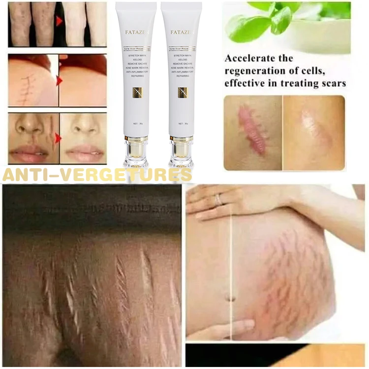 Customize Logo 30g Women Face Body Care Scar Repair Cream Acne Treatment Firming Fast Effective Scar Removal Cream