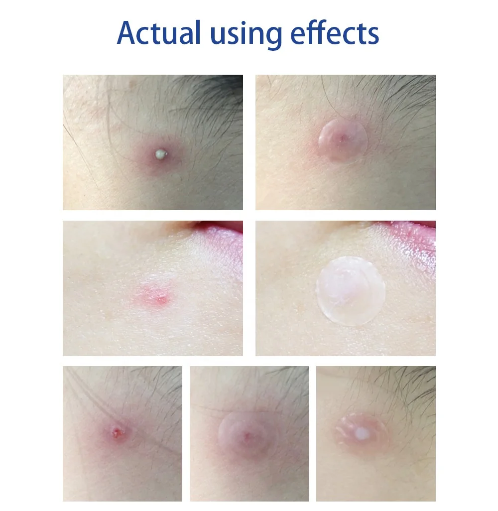 LANBENA Acne Pimple Patch 28pcs Invisible Acne Stickers Blemish Treatment Acne Master Pimple Remover Tool Skin Care Face Cream