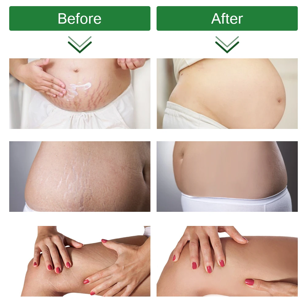 ELAIMEI Beauty Products Anti-Stretch Mark Cream Best Buttock Abdominal Pregnancy Stretch Mark Removal Cream for Legs and Thighs