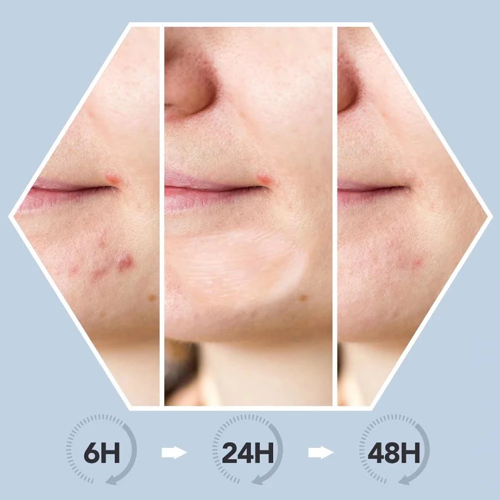 Post Blemish Color correcting Cream Replenish and Soothe Dry Skin After a Pimple Pops Vegan Friendly Formula Rescue Balm