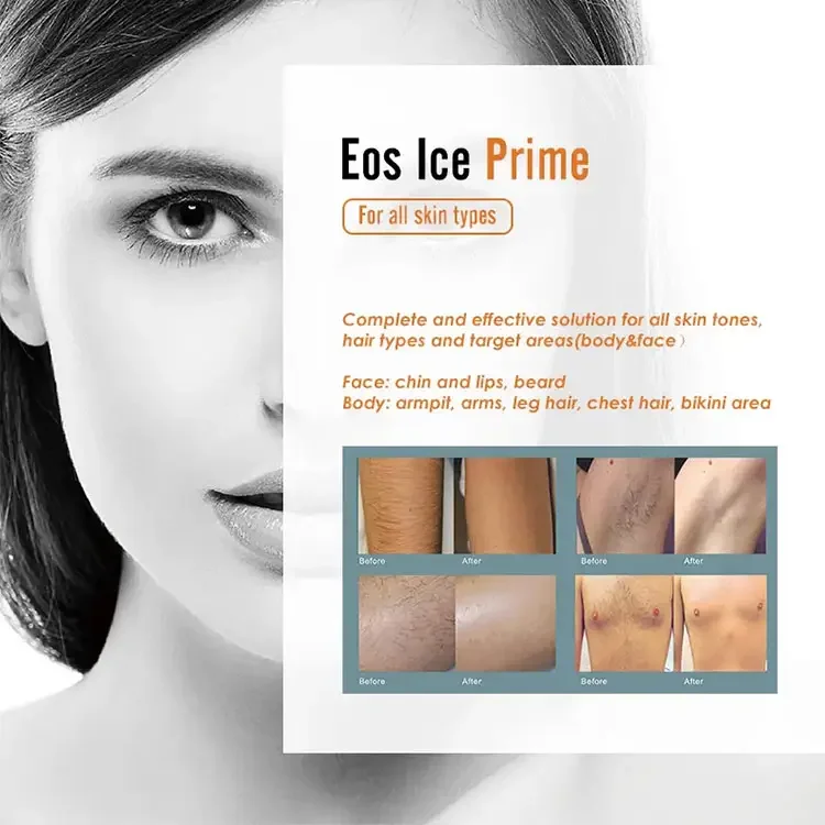 Eos Ice laser 808 1064 755 для безболезненного удаления волос диодный лазер с тремя длинами