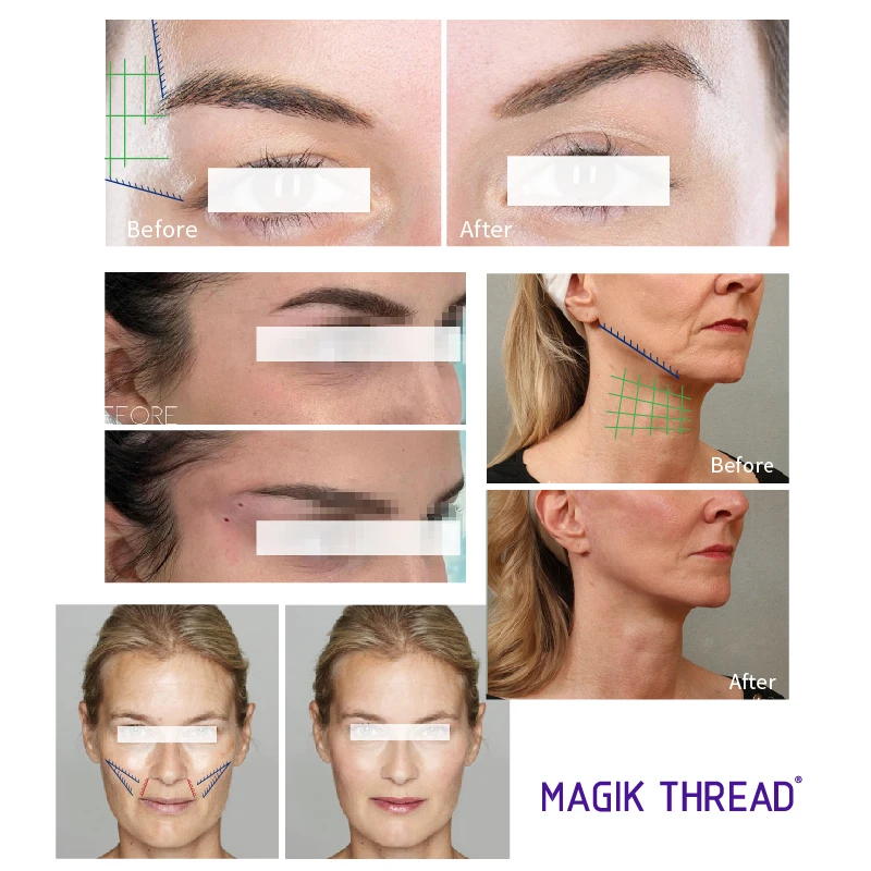 Magik Thread absorbable pdo thread COG 3D online prices tensioning threads lifting face from korea material