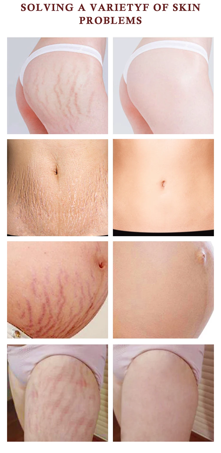 New Arrival Skin Care Pregnancy Slack Anti Stretchmark Scar Repair Body Stretch Marks Removal Cream for Selling