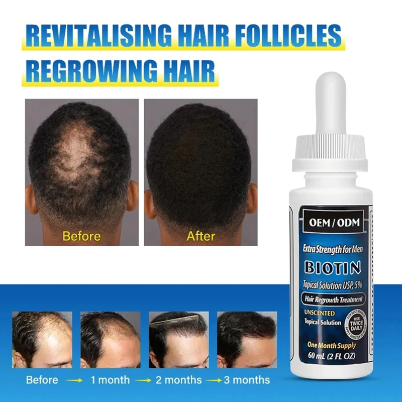 OEM ODM 2% 5%Hair Regrowth Treatment Serum Prevents Hair Loss Hair Growth Oil For Men And Women