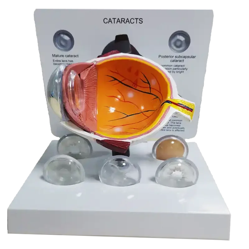 Патологическая анатомическая модель для изучения заболеваний глаз катаракты