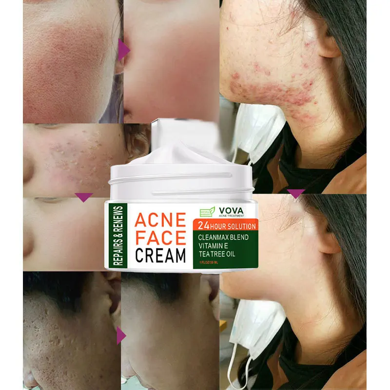 VOVA Acne Removal Cream Herbal Acne Spots Oil Control Acne Cream Skin Care Whitening Moisturizing Face Gel Skin Care