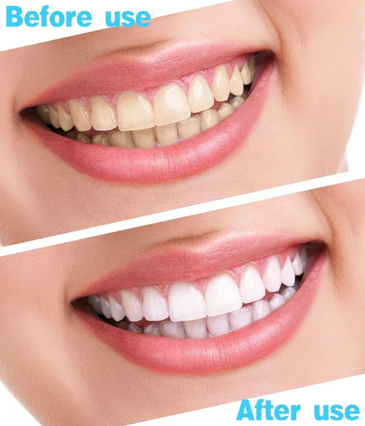 Private Label Professional White Teeth Deep Cleaning Advanced 7d White Dazzle Teeth Whitening Strips