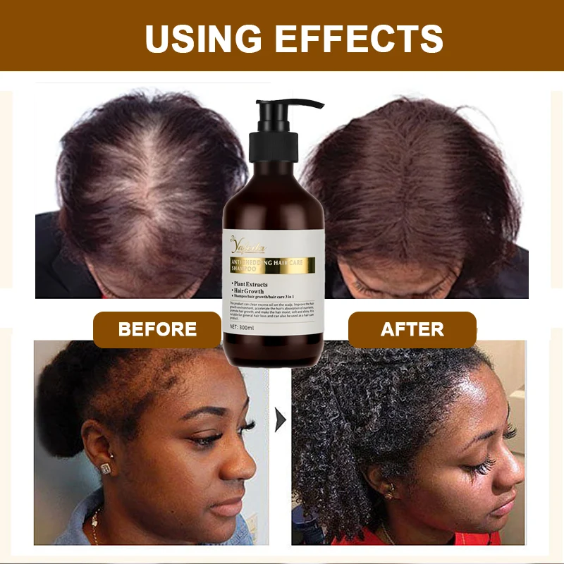 Free Sample Provide Wholesale Chinese Herbal Polygonum Multiflorum Fast Hair Growth Shampoo and Conditioner for Thinning Hair