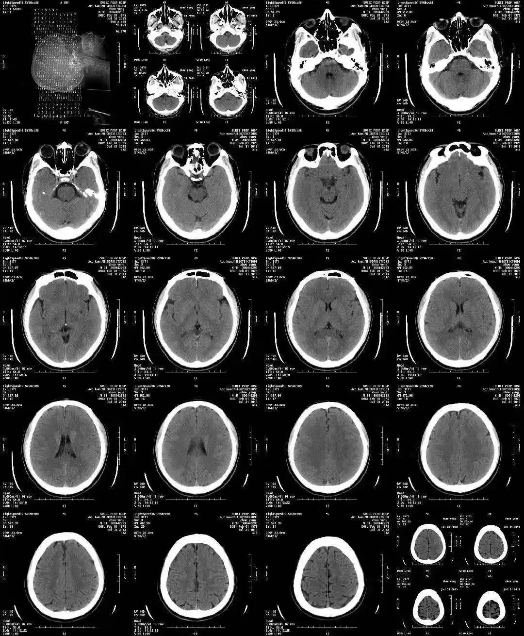Medical X-Ray Thermal Film CT Scan 14x17inch x Ray Film Medical Film For Agfa Drystar 5302
