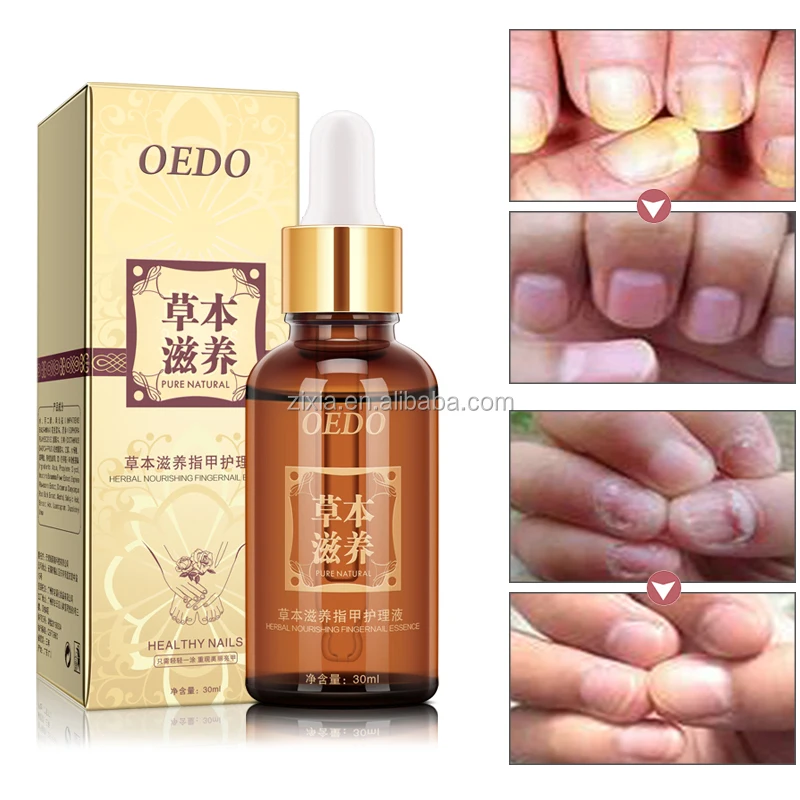 
2020 Wholesale herbal nail repair essence nail treatment for ingrown toa nail anti onychomycosis 