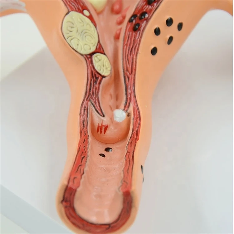 Factory Educational equipment female human anatomy uterine lesion model PVC anatomical model