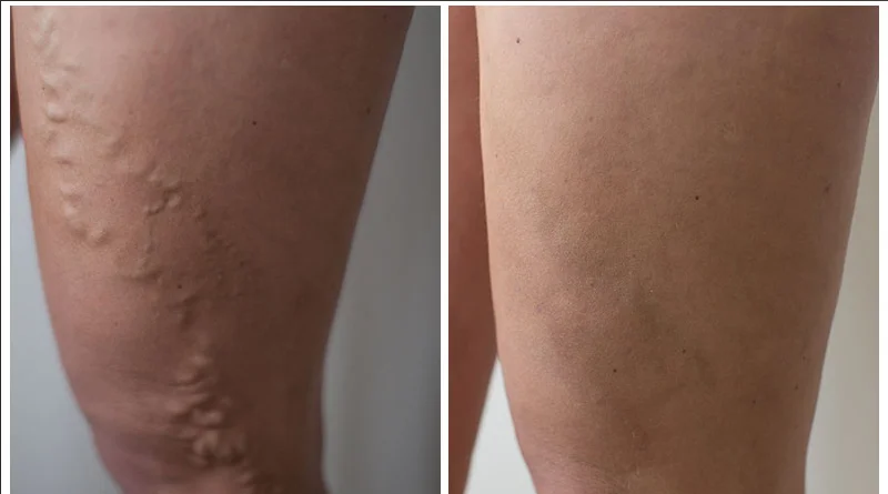 980nm laser vascular removal /spider vein removal / 980nm spider vien removal machine Endoskin laser lifting face laser eyebag