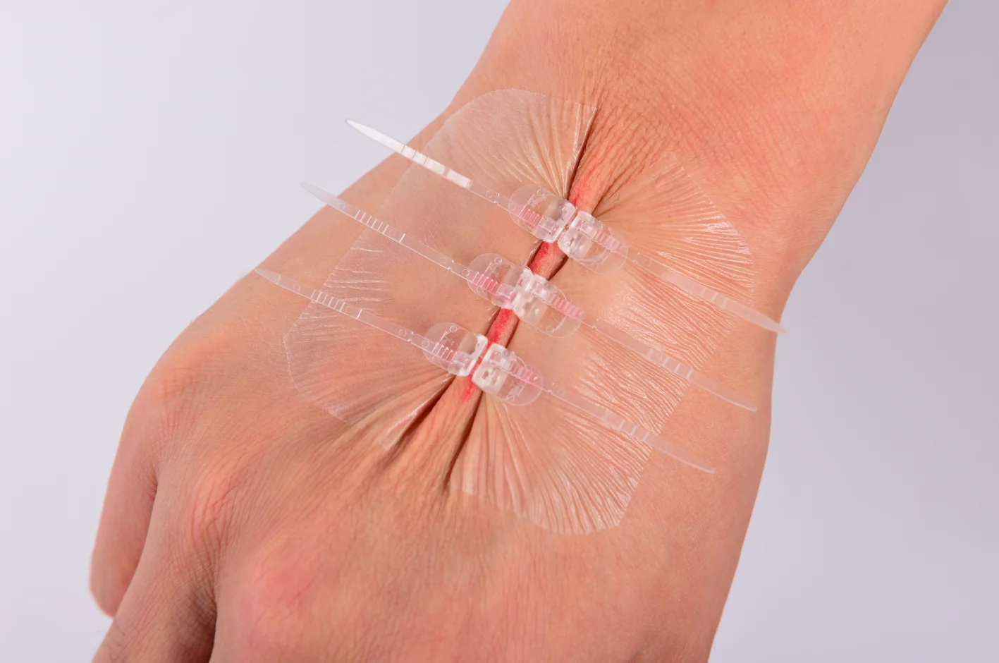 Medical Sterile Skin Closure Device Noninvasive Zip Without Stitches Sterile Strips Without Threads Dressing Wound Closure Strip