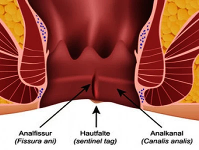 2024 high quality Class IV laser 980nm Anal Fistula surgery laser treatment/1470nm Hemorrhoids Laser Treatment for Proctology
