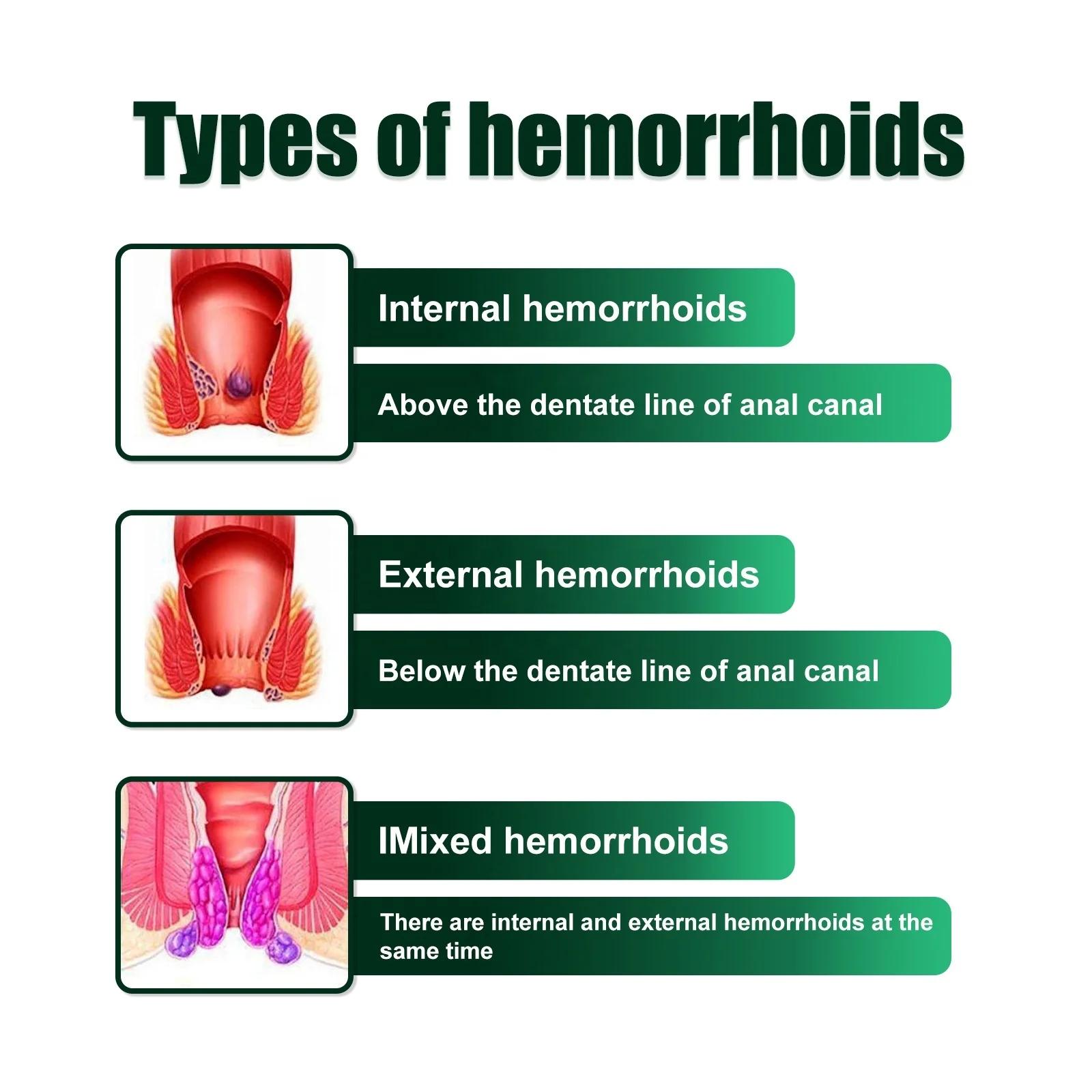 2024 new products hemorrhoids cream anti itch chinese medicine hemorrhoids ointment