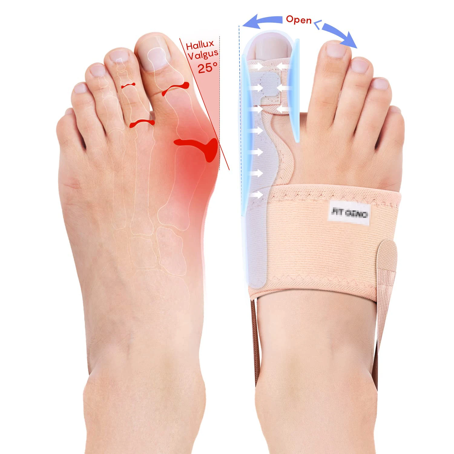 Bunion Corrector for Women Big Toe Upgraded Orthopedic Bunion Splint /Brace - Comfortable Foot Straightener for Hallux Valgus