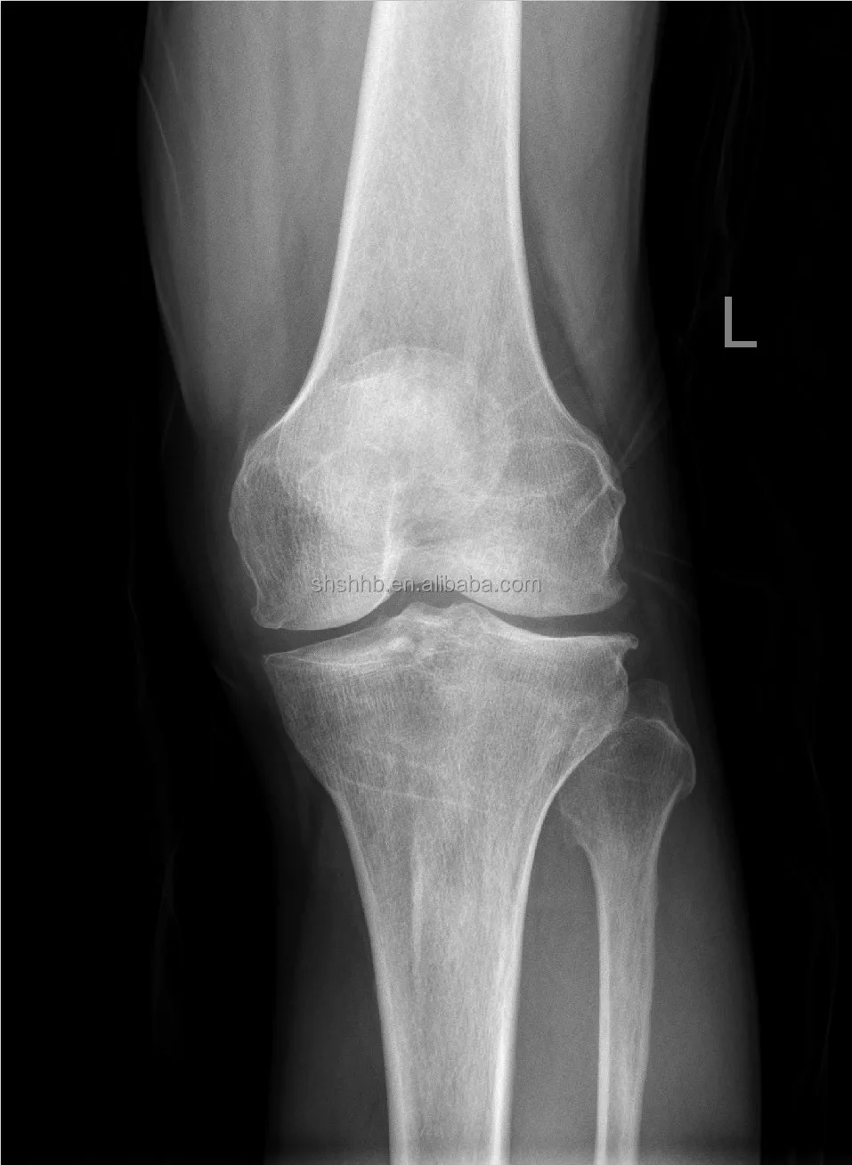 17*17 DR wired flat panel detector Medical multifunction Digital Radiography X-ray flat panel detector